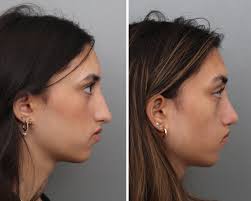 rhinoplasty before and after