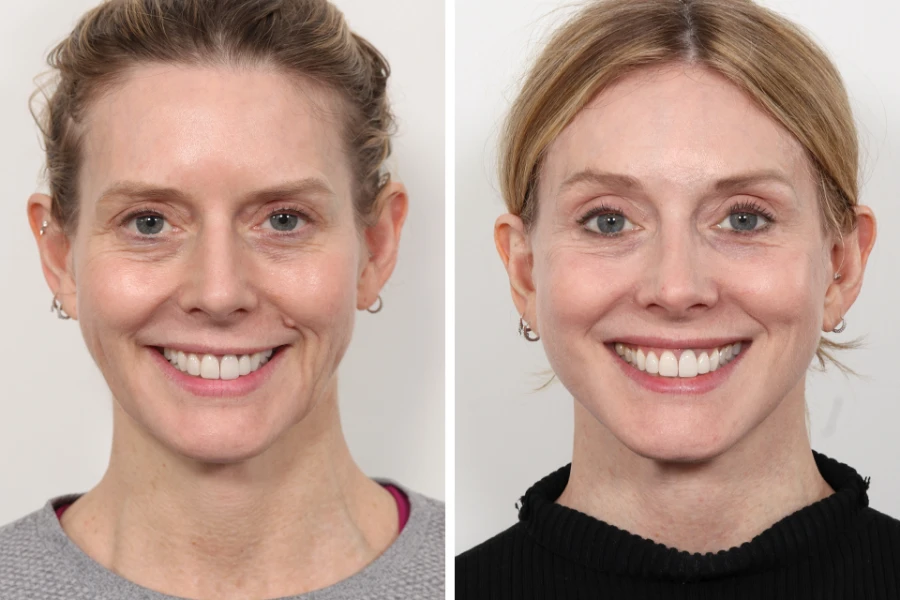 Best Doctors in Dubai for Thread Lift Recommended by Dermatologists