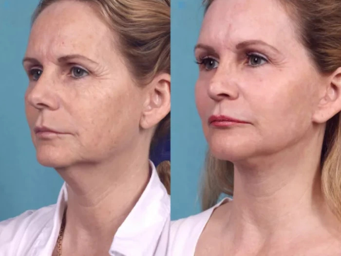 Best Doctors in Dubai for Chemical Peels Tailored to Your Skin Type