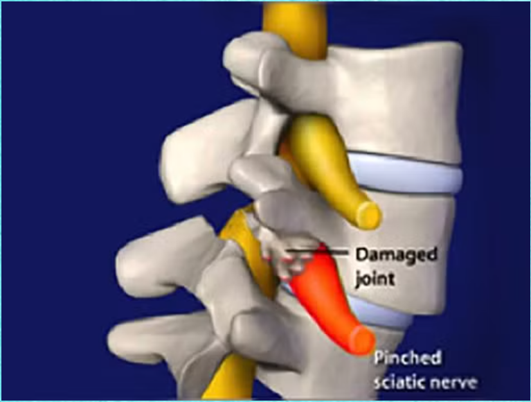 lumbar spine surgery